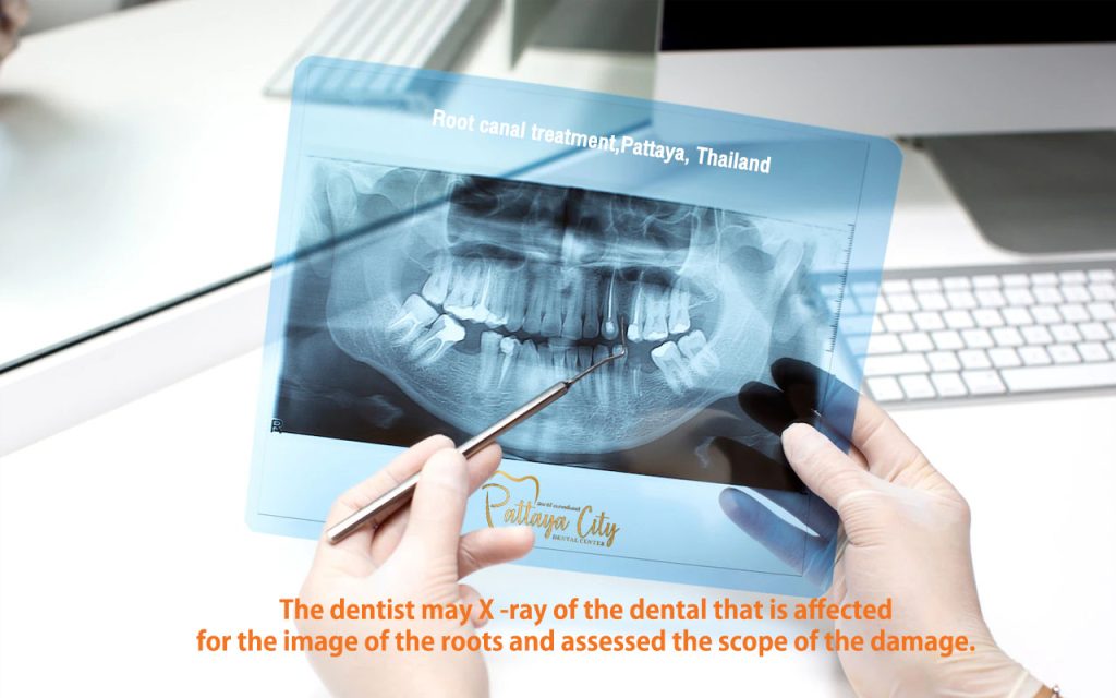 Root canal treatment, รักษารากฟัน พัทยา