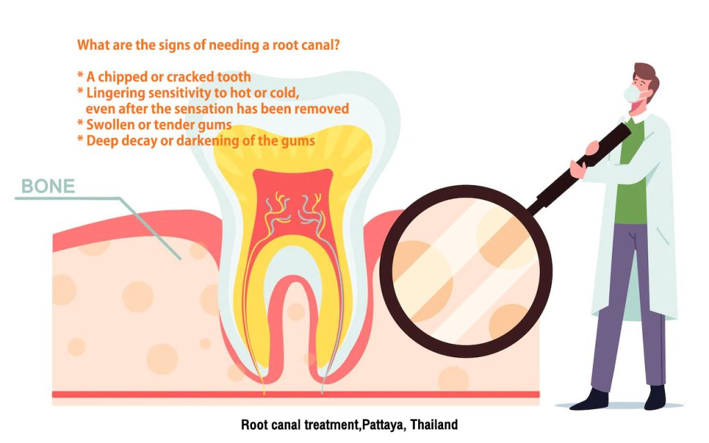 Root canal treatment, รักษารากฟัน พัทยา, Root canal treatment pattaya