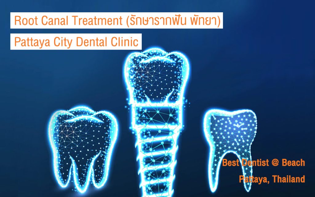 Root canal treatment, รักษารากฟัน พัทยา, Root canal treatment pattaya