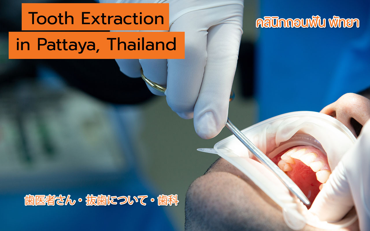 Pattaya City Dental Center, Tooth removal for toothaches and poor prognoses teeth, คลินิกถอนฟัน พัทยา, ถอนฟันใกล้ฉัน, ถอนฟันผุ, ถอนฟันคุด